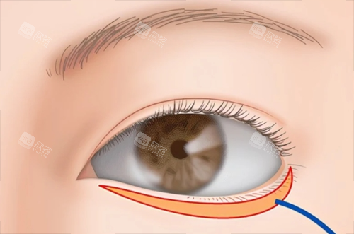 眼睑下至外切标注范围示意图