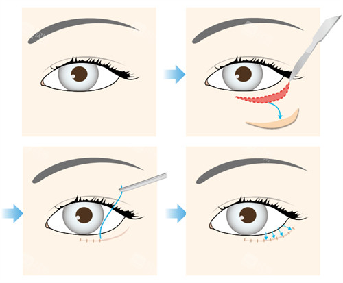 眼睑下至手术操作流程图