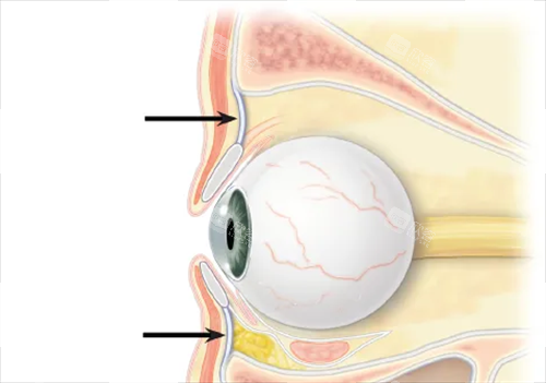 眼睛凹陷侧面示例图