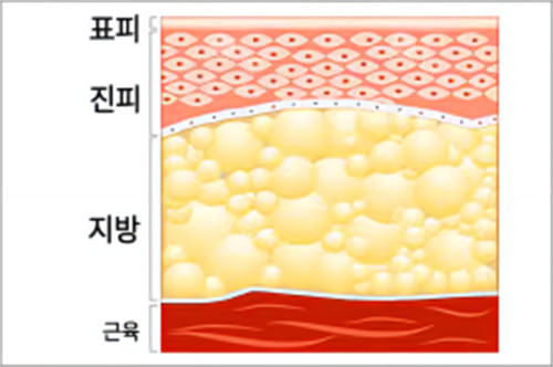 抽脂脂肪层示例图