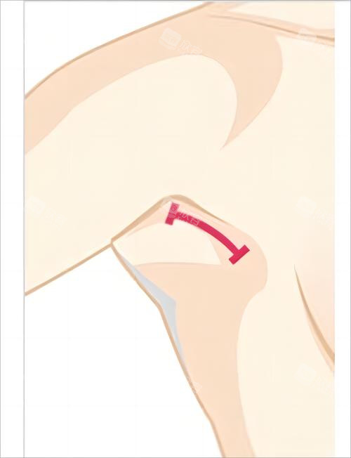 隆胸腋下切口示例图