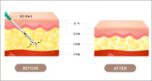 抽脂脂肪前后对比图